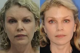 شد الوجه بالخلايا الجذعية في دبي وأبو ظبي