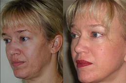 شد الوجه بالخلايا الجذعية في دبي