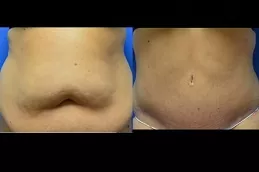 علاج نحت الجسم في دبي وأبو ظبي