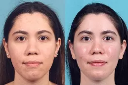 عيادة إزالة دهون الخدود دبي