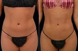 عيادة شفط الدهون في الجسم بأبوظبي