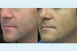 عيادة علاج إزالة الشعر بالليزر للرجال