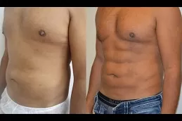 نحت الجسم عالي الدقة في دبي