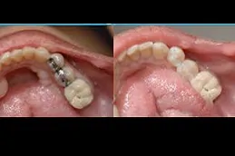 أفضل حشو أسنان في دبي