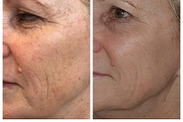 أفضل علاج بقلم البلازما في أبو ظبي