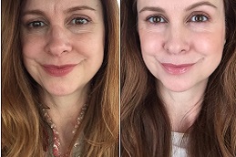 أفضل علاج بقلم البلازما في دبي