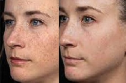 أفضل علاج ديرمابين في دبي