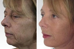 أفضل عملية تجميل غير جراحية في أبوظبي