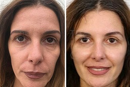 أفضل عملية تجميل غير جراحية في دبي