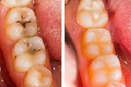 أفضل عيادة حشو الأسنان في دبي