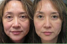 أفضل عيادة علاج بقلم البلازما في دبي