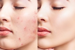 أفضل عيادة لعلاج البثور في دبي