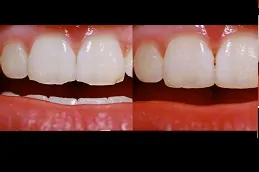 حشو الاسنان في ابوظبي