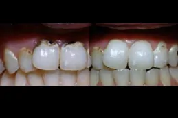 حشو الاسنان في دبي