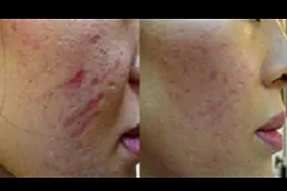 علاج الديرمابين في ابوظبي