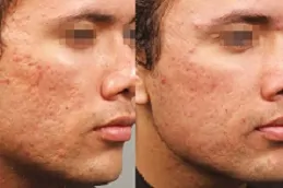 علاج الديرمابين في دبي