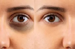 علاج الهالات السوداء في ابوظبي