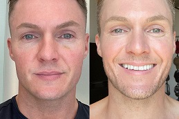 علاج قلم البلازما في أبو ظبي