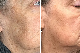 علاج قلم البلازما في دبي