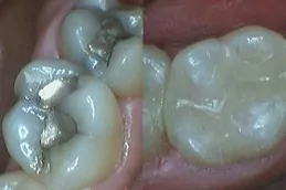 عيادة حشو الأسنان في دبي