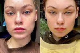 عيادة علاج قلم البلازما في دبي