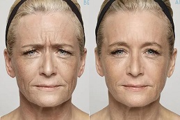 أفضل تنعيم التجاعيد في دبي