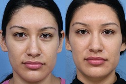 أفضل حقن الفيلر في أبو ظبي