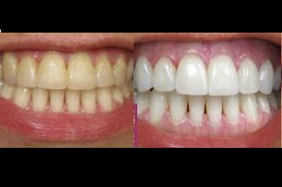 أفضل شركة تنظيف أسنان في أبو ظبي