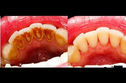 أفضل عيادة تنظيف أسنان في دبي