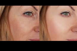 أفضل عيادة تنعيم التجاعيد في دبي