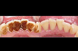 تنظيف الاسنان في ابوظبي