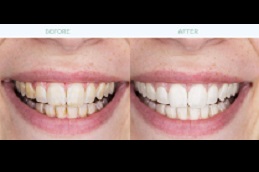 تنظيف الاسنان في دبي