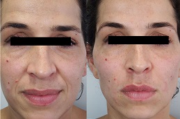 حقن الفيلر في ابوظبي