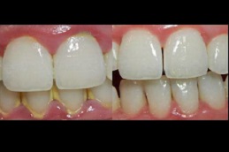 عيادة تنظيف الأسنان في دبي