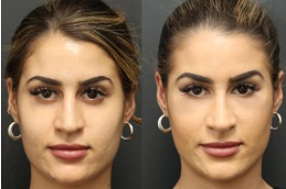 نحت الوجه في دبي