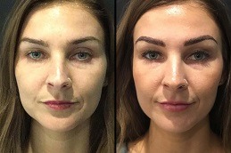 أفضل حقن الفيلرز في دبي