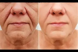 أفضل عيادة حقن الفيلرز دبي