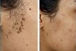 أفضل علاج التقران المثي في دبي