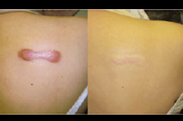 أفضل علاج الجدرة دبي