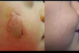 أفضل علاج الجدرة في دبي