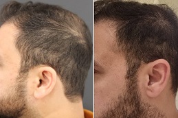 أفضل علاج ريجينيرا أكتيفا دبي