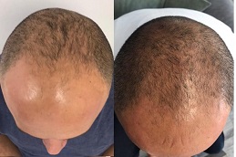 أفضل علاج ريجينيرا أكتيفا في دبي