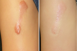 أفضل عيادة علاج الجدرة دبي