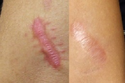 أفضل عيادة علاج الجدرة في دبي