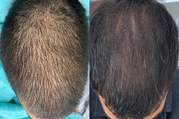 أفضل عيادة علاج ريجينيرا أكتيفا دبي