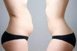 افضل شفط دهون في ابوظبي