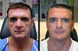 العلاج بالخلايا الجذعية دبي