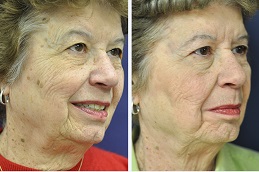 علاج التقران المثي دبي