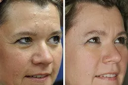 علاج التقران المثي في دبي