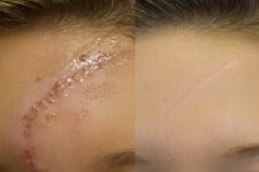 علاج الجدرة دبي